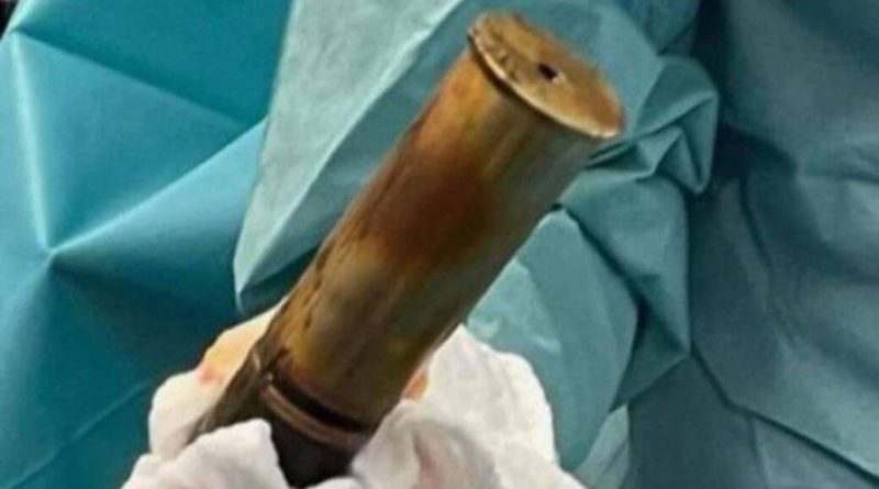 Arriva in ospedale con un proiettile d’artiglieria nel retto, allarme bomba